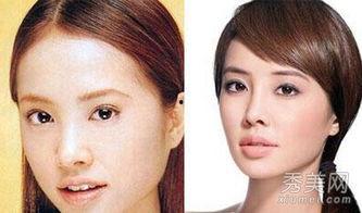 明星隆鼻,明星蜕变背后的秘密